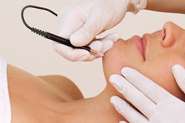 Electrolysis: Permanent Hair Removal